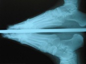 X-ray of Foot